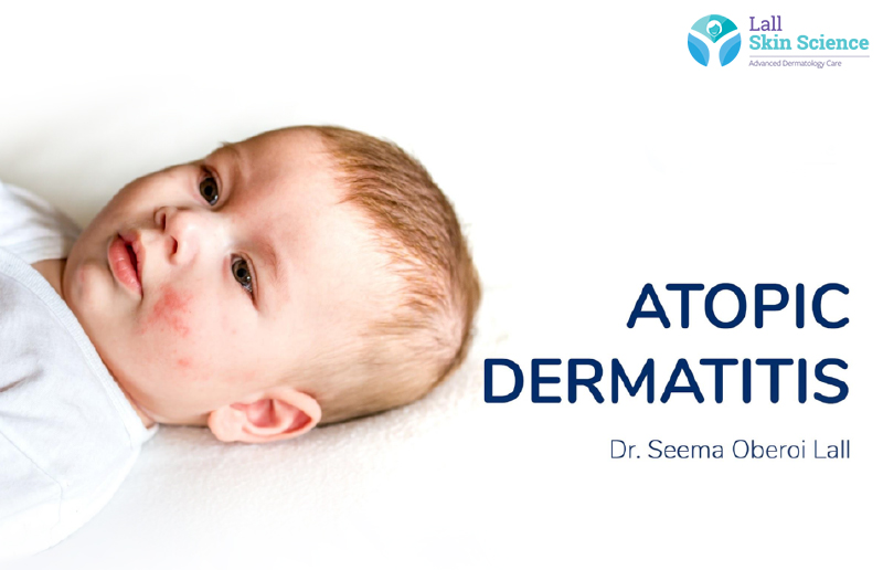 Stock fotó — Allergies, atopic dermatitis on the face of a baby