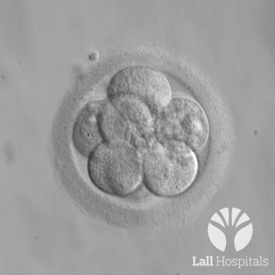 In vitro Fertilisation IVF