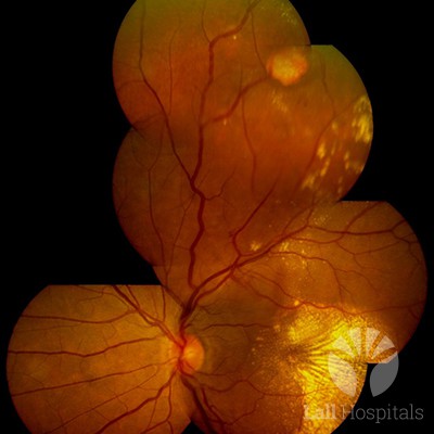 Retinal-capilary-hemangioma