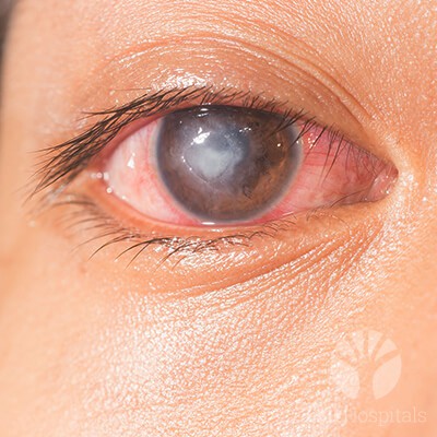 lall-eyecare-p-corneal-diseases