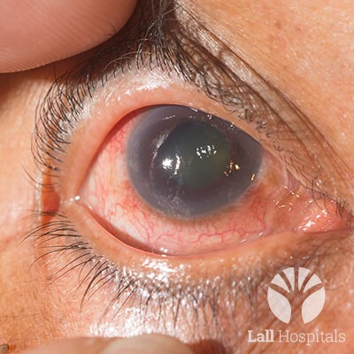 lall-eyecare-p-glaucoma-1