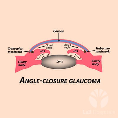 lall-eyecare-p-glaucoma-closed-angle-glaucoma
