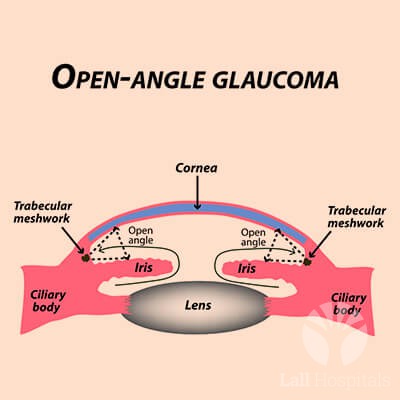 lall-eyecare-p-glaucoma-openangle-glaucoma-common