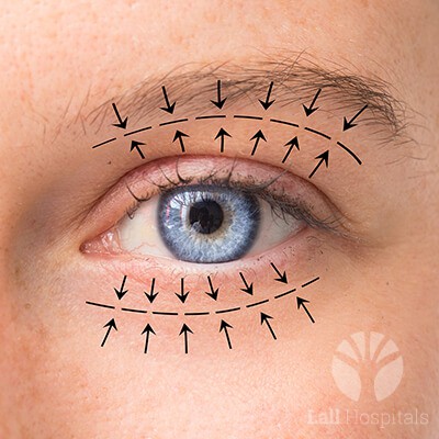 lall-eyecare-p-oculoplasty-1