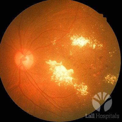 lall-eyecare-p-retinal-diseases