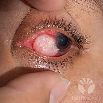 lall-eyecare-p-retinal-diseases-diagnostic-tool-retinal-dieses