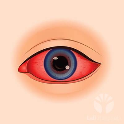 lall-eyecare-p-uveitis-and-ocular immunology